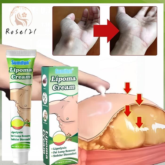Gambar dari Obat Salep Cream Ampuh Hilangkan Benjolan Lipoma Kelenjar Tiroid