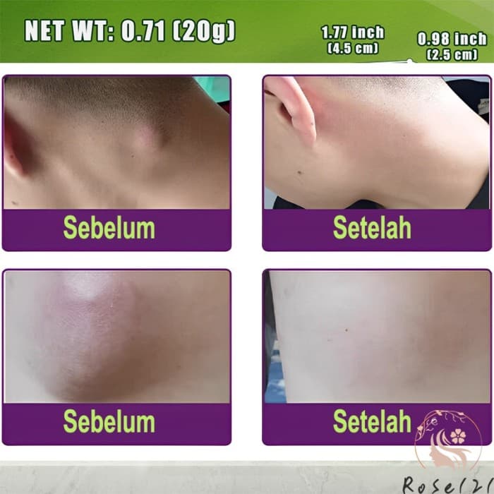 Gambar dari Obat Salep Cream Ampuh Hilangkan Benjolan Lipoma Kelenjar Tiroid