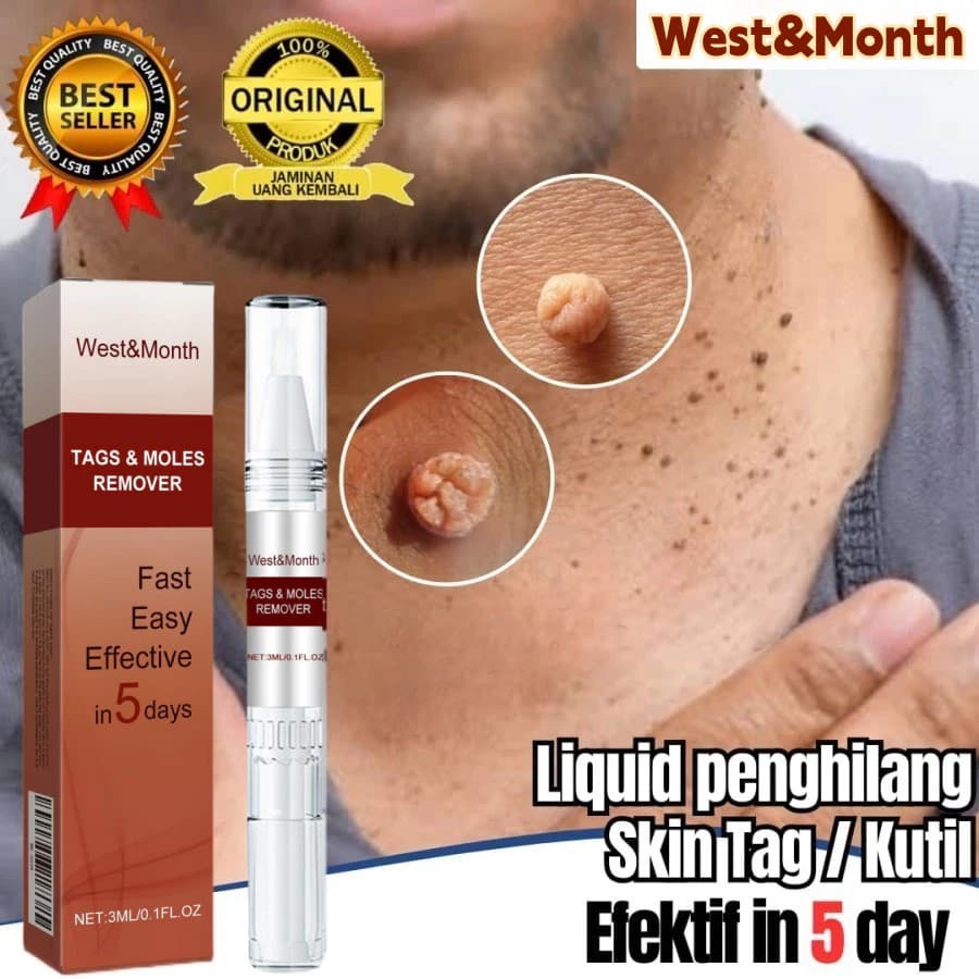 Tags & Moles Remover Krim Penghilang Kutil dan Tahi Lalat